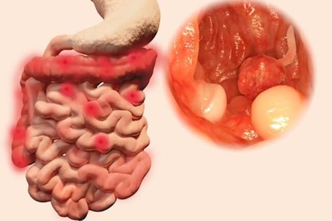 انواع پولیپ روده بزرگ